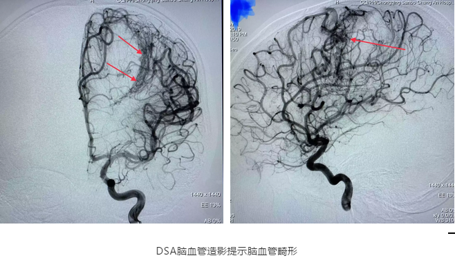 脑血管造影（DSA）证实为脑血管畸形