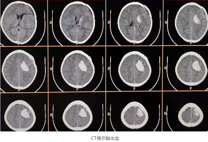 CT检查确诊为脑出血