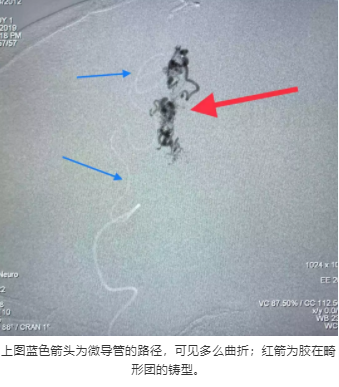 上图蓝色箭头为微导管的路径，可见多么曲折；红箭为胶在畸形团的铸型。