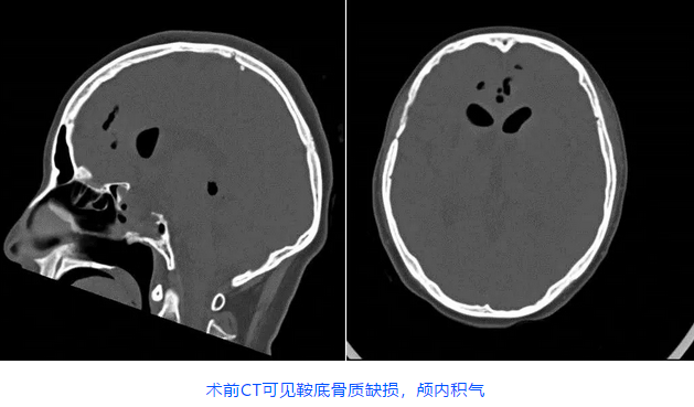 术前CT可见鞍底骨质缺损,颅内积气