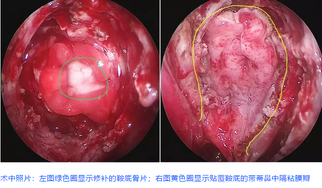 术中照片:左图绿色圈显示修补的鞍底骨片;右图黄色圈显示贴覆鞍底的带蒂鼻中隔粘膜瓣