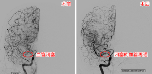 2个月内脑梗2次 脑血管里“穿针引线”妙手“疏堵”