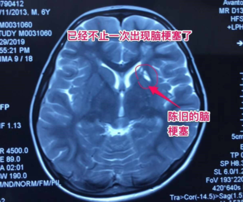 中老年多发脑梗，6岁儿童竟中招！说话不清、肢体无力、活动障碍、头晕头痛…要警惕！