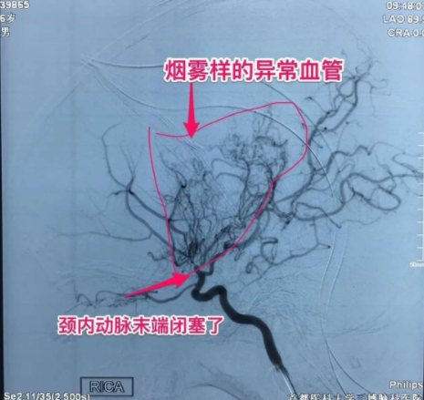 中老年多发脑梗，6岁儿童竟中招！说话不清、肢体无力、活动障碍、头晕头痛…要警惕！