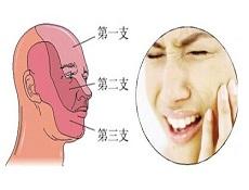 三叉神经痛 三叉神经痛