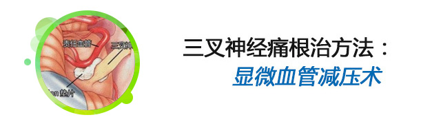 三叉神经痛和偏头痛 三叉神经痛和偏头痛