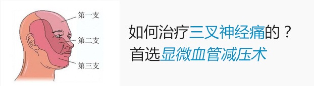 怎么治疗三叉神经痛? 怎么治疗三叉神经痛?