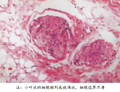 颅内外沟通性脑膜瘤怎么治疗好？