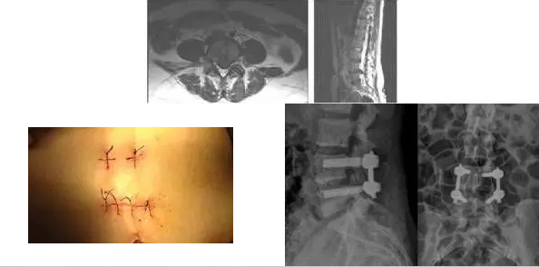 病例二腰椎间盘突出+腰椎管狭窄