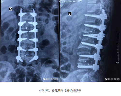 术后DR,脊柱畸形得到很好改善 术后DR,脊柱畸形得到很好改善