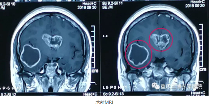 术前MRI