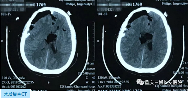 术后复查CT 术后复查CT