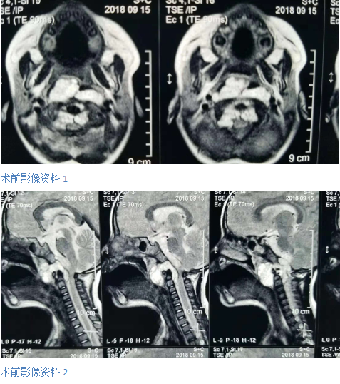 小孩子睡觉打鼾警惕藏有巨大危险