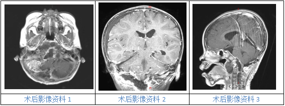 手术切掉了威胁琪琪的肿瘤