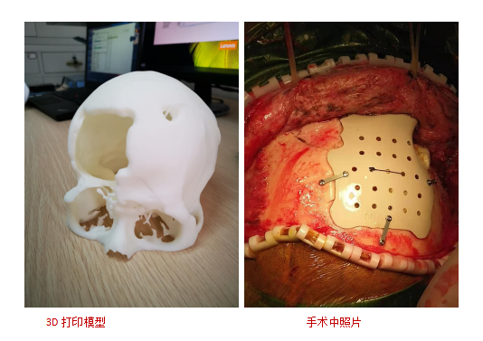 右额骨和眉弓粉碎性骨折 右前额出现大坑怎么办