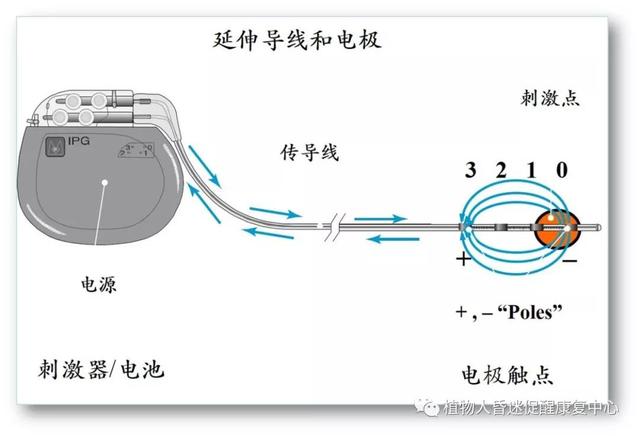 “植物人”真的无法醒过来吗?这3种方法为昏迷促醒提供更多可能 “植物人”真的无法醒过来吗?这3种方法为昏迷促醒提供更多可能