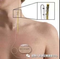 “植物人”真的无法醒过来吗?这3种方法为昏迷促醒提供更多可能 “植物人”真的无法醒过来吗?这3种方法为昏迷促醒提供更多可能