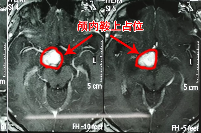 胸部变大的男孩,竟是因为脑中长了肿瘤 胸部变大的男孩,竟是因为脑中长了肿瘤